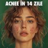 Cum să scapi de acnee in 14 zile